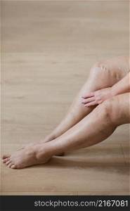 The woman rubs tired legs with a special cream to reduce pain. Phlebology. Painful varicose and spider veins on active female legs, medicine and health. The woman rubs tired legs with a special cream to reduce pain. Phlebology. Painful varicose and spider veins on active female legs, medicine and health.