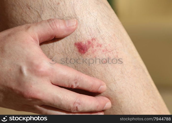 The wound on man&#39;s leg