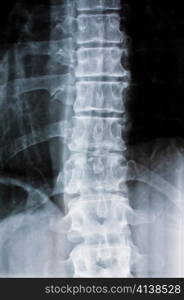 the x-ray of a spine. prevention in medicine