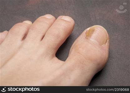 Toenails with fungus problems,Onychomycosis, also known as tinea unguium, is a fungal infection of the nail, dark background.