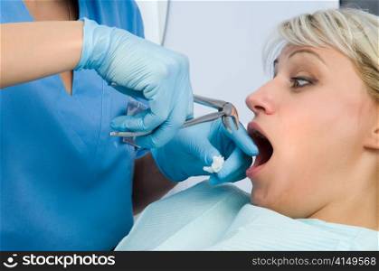 tooth extraction using forceps, scared patient. tooth extraction, scared patient