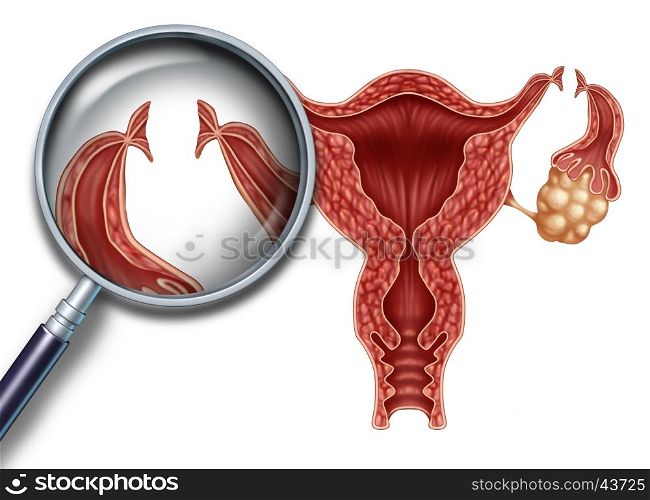 Tubal ligation reproduction medical procedure for female sterilization as a uterus with incisions on the fallopian tubes to block the egg from being fertilized as a fertility and gynecology medicine concept with 3D illustration elements.