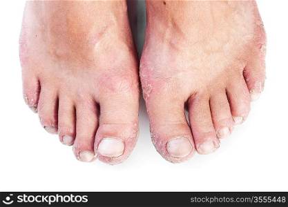 two male feet with eczema isolated on white background