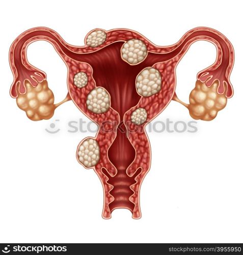 Uterine fibroid medical concept as a human female reproduction uterus disease symbol for fertility problems and reproductive system health.