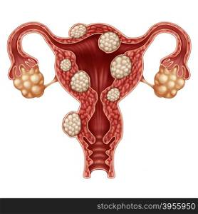 Uterine fibroid medical concept as a human female reproduction uterus disease symbol for fertility problems and reproductive system health.