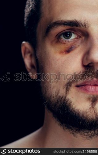 Violence fight eye hematoma shiner close-up. Portrait of a man with bruised skin and black eye.
