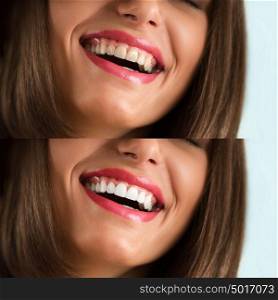 Whitening - bleaching treatment, before and after, woman teeth and smile, closeup portrait