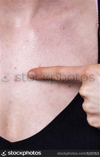 Woman having pimples, red spots on her chest. Dermatoses, skin condition problems, dermatological problem during puberty.. Woman having pimples red spots on chest