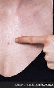 Woman having pimples, red spots on her chest. Dermatoses, skin condition problems, dermatological problem during puberty.. Woman having pimples red spots on chest