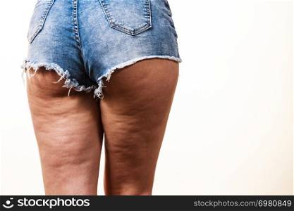 Woman legs thighs with cellulite skin problem. Body care, overweight and dieting concept.. Woman legs with cellulite skin