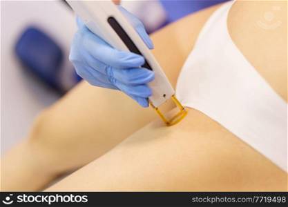 Woman receiving groins laser hair removal at a beauty center. Laser depilation treatment in an aesthetic clinic.. Woman receiving groins laser hair removal at a beauty center.