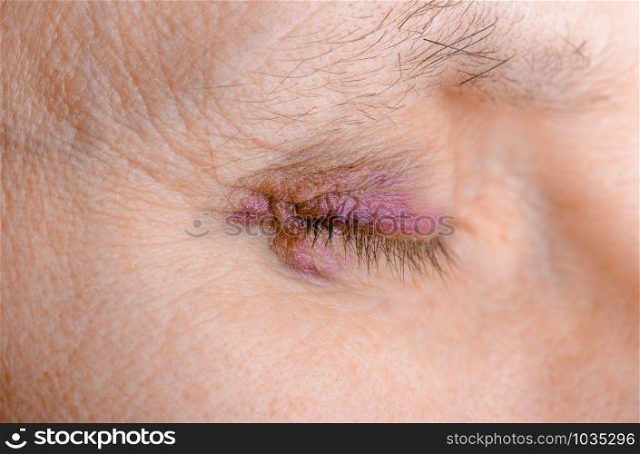 Woman&rsquo;s eye injured due to rupture of capillary, causing hematoma or bruising. It could also be conjunctivitis or other allergic eye inflammation