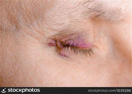 Woman&rsquo;s eye injured due to rupture of capillary, causing hematoma or bruising. It could also be conjunctivitis or other allergic eye inflammation