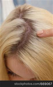 Woman showing her hair regrowth roots after blonde dying. Close up of female head.. Woman showing blonde hair roots