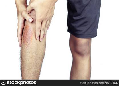 Wound in men&rsquo;s legs, caused by sports.