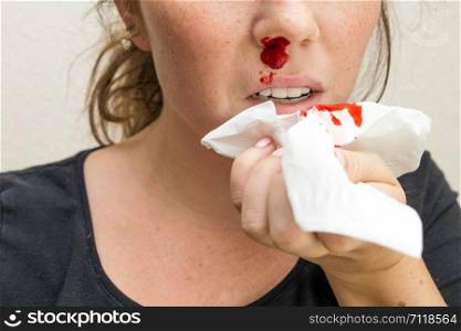 Wound nosebleed, woman bleeding from her nose, nose injury blood and tissue accident. Wound nosebleed, woman bleeding from her nose, nose injury blood and tissue