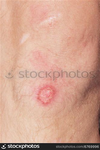 wound on a knee