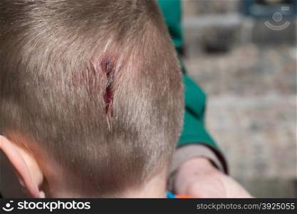 Wound on head injury. A young boy with a small wound on his head injury