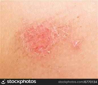 wound on human skin