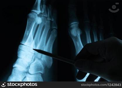 X ray film with doctor&rsquo;s hand to examine