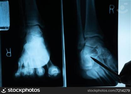 X ray film with doctor&rsquo;s hand to examine