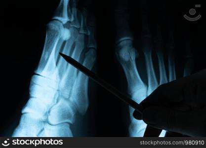 X ray film with doctor's hand to examine