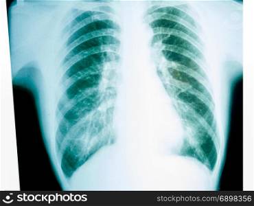 X-ray of a human male chest