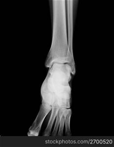 x-ray of ankle