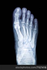 x-ray of foot on black background