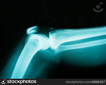 X-ray of human arm showing broken bone