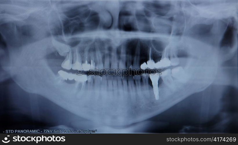 X-ray of the jaw close up