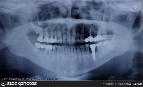 X-ray of the jaw close up