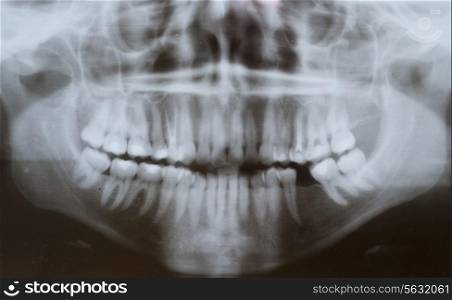 X-ray panoramic picture jaw