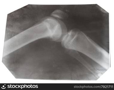 X-ray photo of human knee joint isolated on white background