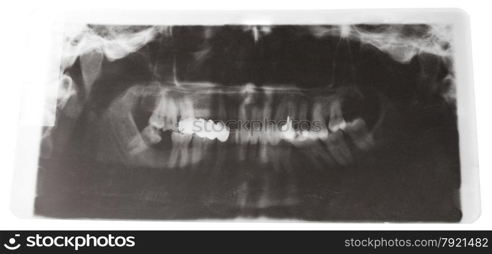 X-ray picture of human jaws with dental crown isolated on white background