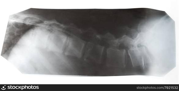 X-ray picture of human vertebral column isolated on white background