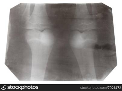 X-ray picture of two human knee-joints isolated on white background
