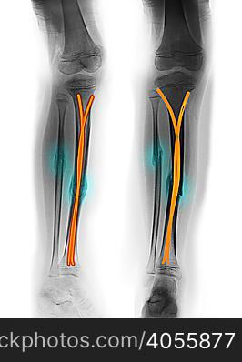 x-ray showing tibia and fibula fracture — Stockphotos.com