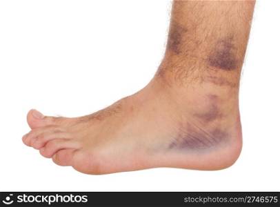 young male with sprained ankle isolated on white background