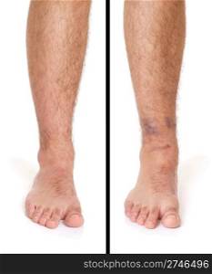 young male with sprained ankle isolated on white background (healthy vs unhealthy)