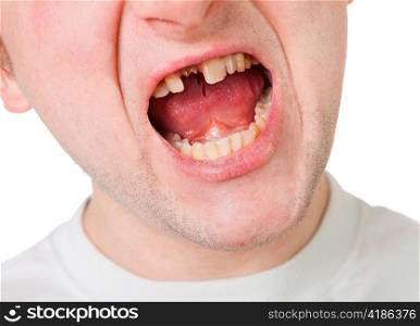 Young man face with broken tooth, closeup view isolated on white