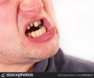 Young man face with broken tooth on grey background