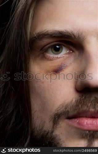 Young man portrait with bruise black eye shiner hematoma. Domestic assault violence concept.