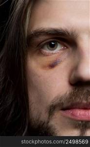 Young man portrait with bruise black eye shiner hematoma. Domestic assault violence concept.