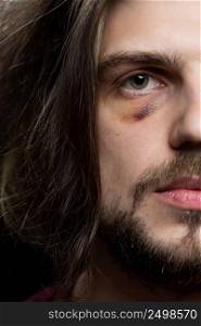 Young man with bruise black eye hematoma, domestic violence victim concept.