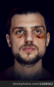 Young man with bruise black eye hematoma, violence victim.
