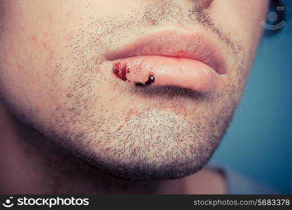 Young man with dried blood from a cold sore on his lip