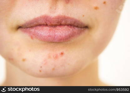 Young woman showing her face with acne and moles, dry lips. Teen girl no make up with red spots on her chin. Health problem, skin diseases.. Female face with acne skin problem