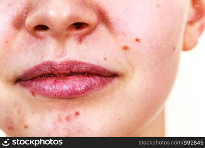 Young woman showing her face with acne and moles, dry lips. Teen girl no make up with red spots on her chin. Health problem, skin diseases.. Female face with acne skin problem