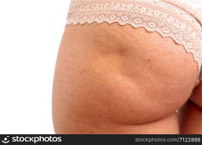 young woman shows her buttocks with cellulite and stretch marks on white isolated background. concept for medicine and cosmetology/